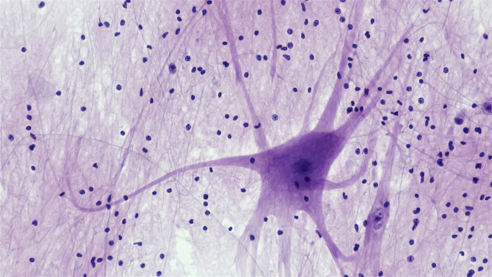 Alcohol-cue brain response linked to heavier real-world drinking